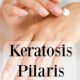 Keratosis Pilaris – Dealing with Chicken Skin